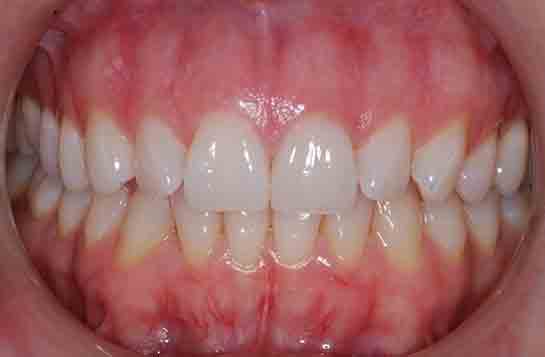 Diş Eti Hastalıkları Bitkisel Tedavisi